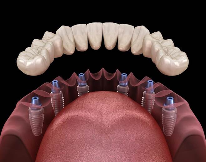 Bridge transvisse implant-dentaire