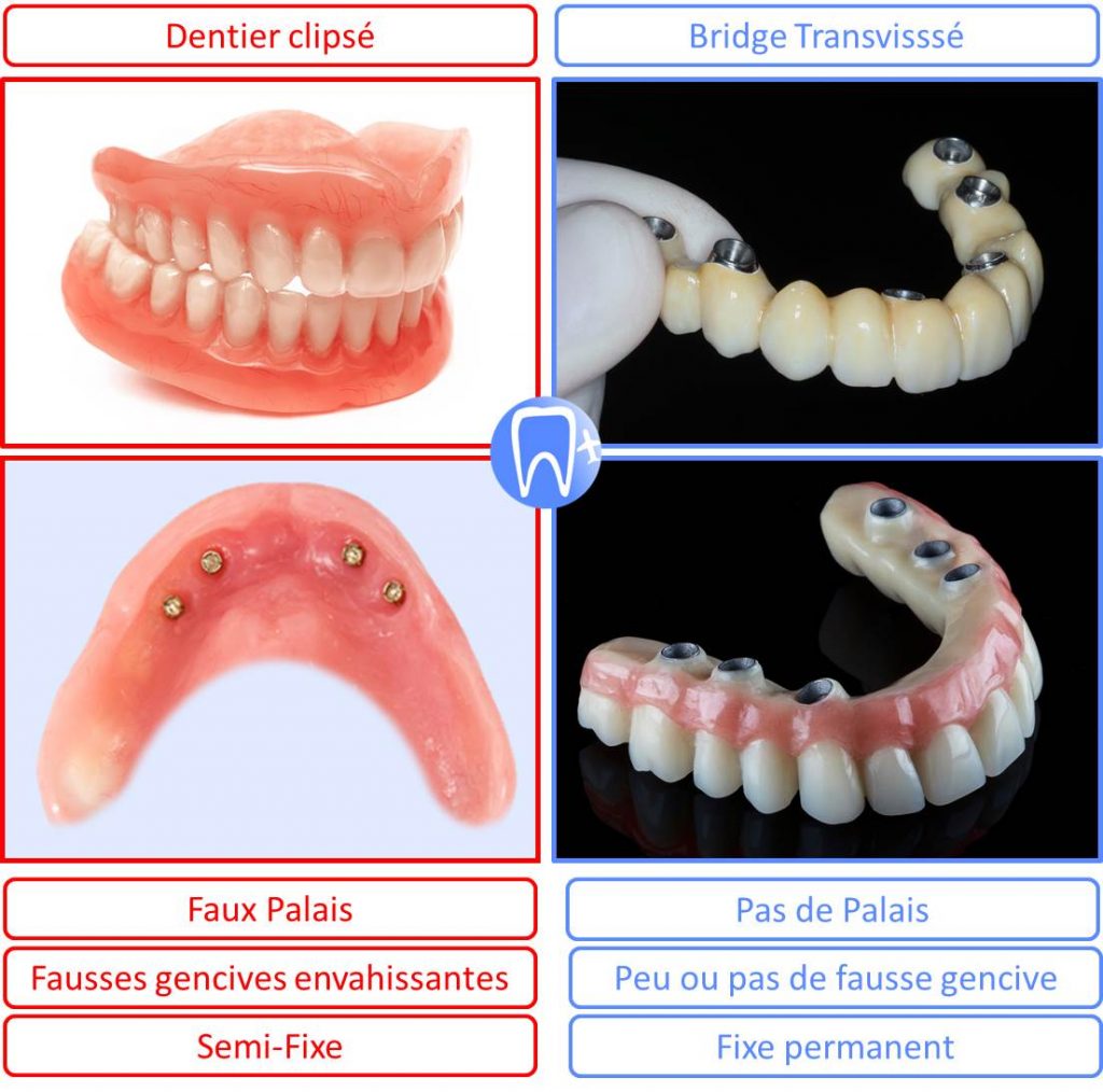 Dentition complete fixe avec bridge ou dentier