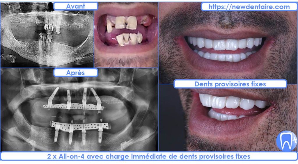 dentition complete fixe sur implant dentaire - Newdentaires