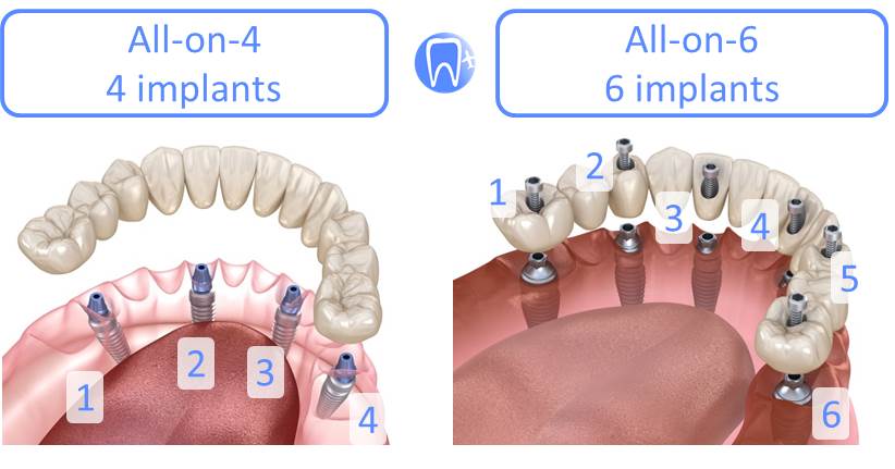 Dentition sur implant All-on-4