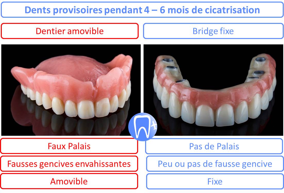 Dents provisoires bouche complete implants