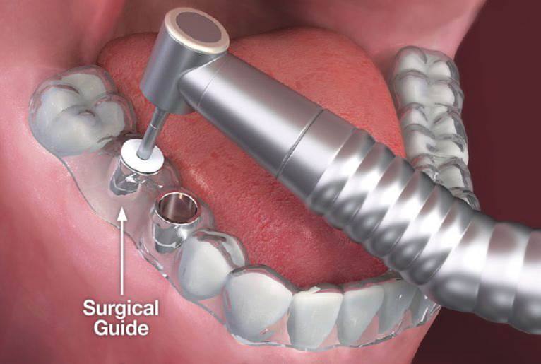 Guidage numerique implant dentaire