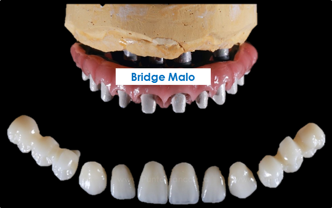 Refaire dentition complete bridge Malo