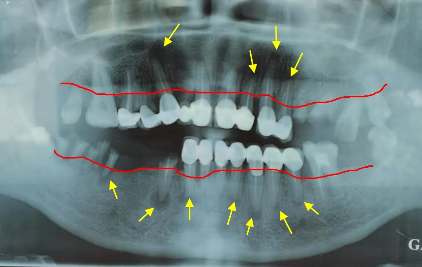 Refaire dents radiographie
