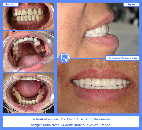Refaire ses dents - Newdentaires