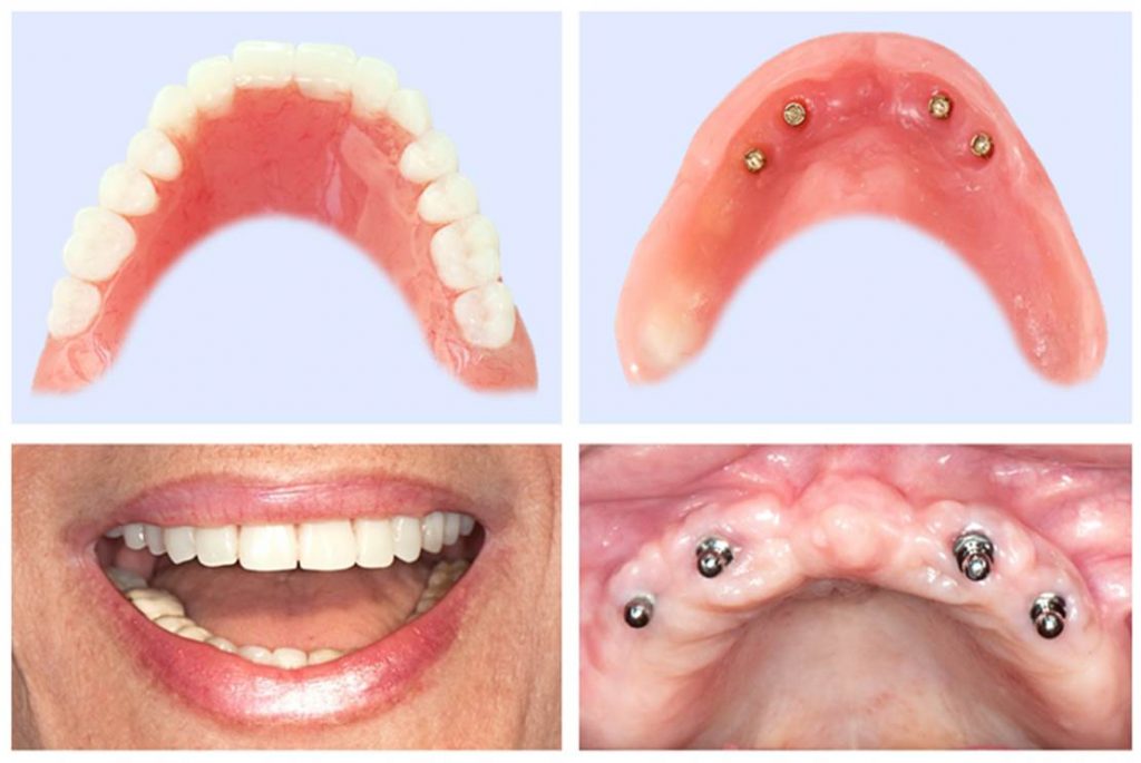 Refaire ses dents avec implant dentaire
