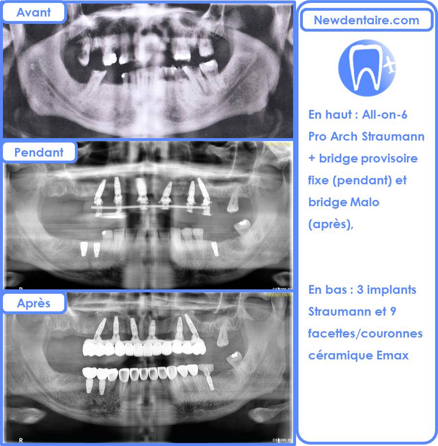 radiographie refaire dents
